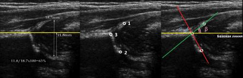 Протокол узи тазобедренных суставов у детей. УЗИ тазобедренных суставов у младенцев