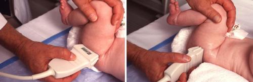 Протокол узи тазобедренных суставов у детей. УЗИ тазобедренных суставов у младенцев