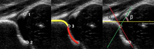 Протокол узи тазобедренных суставов у детей. УЗИ тазобедренных суставов у младенцев