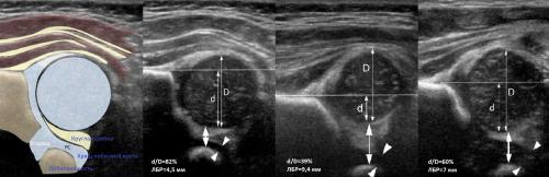 Протокол узи тазобедренных суставов у детей. УЗИ тазобедренных суставов у младенцев