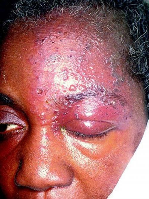 Воспаление тройничного лицевого нерва. Симптомы невралгии тройничного нерва 01 Воспаление тройничного лицевого нерва. Симптомы невралгии тройничного нерва 01