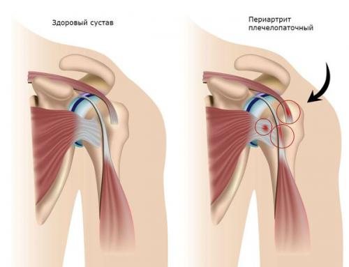 Почему щелкает плечевой сустав. Остеоартроз 05