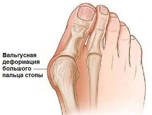 Вальгусная деформация первого пальца стопы. Что такое плоско-вальгусная деформация стопы 02 Вальгусная деформация первого пальца стопы. Что такое плоско-вальгусная деформация стопы 02