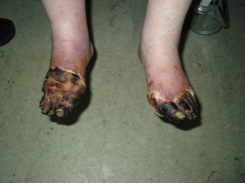 Кожные маркеры сахарного диабета: что это и как их обнаружить 02 Кожные маркеры сахарного диабета: что это и как их обнаружить 02