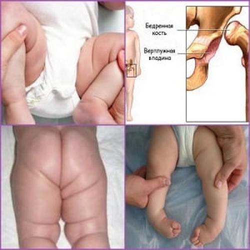 Ацетабулярный угол разный. Что такое ацетабулярные углы
