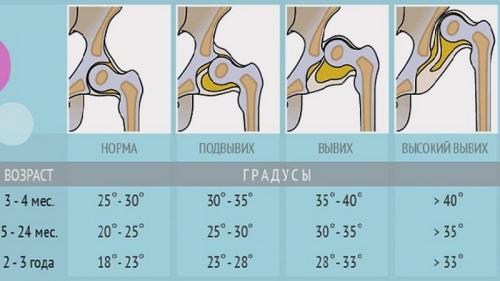 Ацетабулярный угол норма в 3 года. Что такое ацетабулярные углы