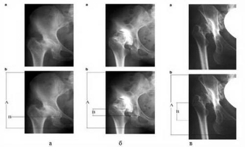 Ацетабулярный индекс норма в 6 месяцев. Статья 01