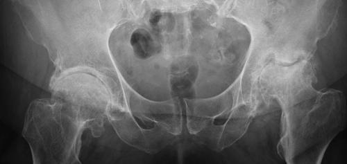 Самые эффективные препараты при коксартрозе. Методы диагностики заболевания