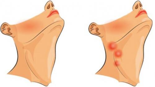Увеличение лимфатических узлов у детей. Лимфаденопатии у детей 01 Увеличение лимфатических узлов у детей. Лимфаденопатии у детей 01