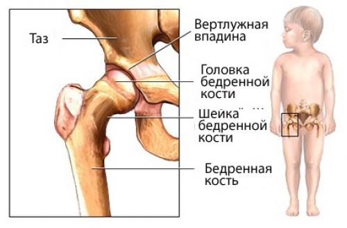Дисплазия у детей МКБ-10. Статистика