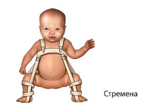 Как носить ребенка при дисплазии. Слинг при дисплазии тазобедренного сустава у младенцев
