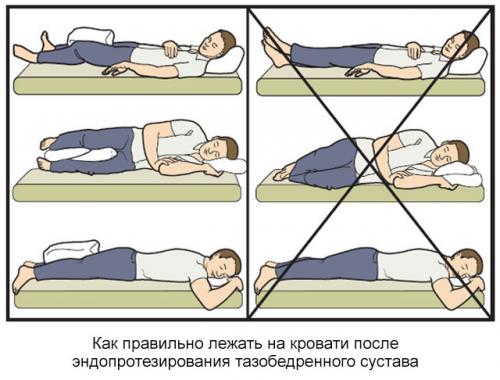 Поздняя реабилитация после эндопротезирования тазобедренного сустава. Описание реабилитации после операции по эндопротезированию тазобедренного сустава