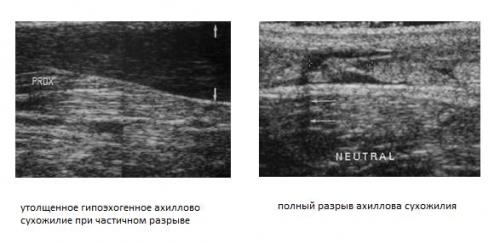 Травматические повреждения мышц и сухожилий на уровне голени: причины, симптомы и лечение 03
