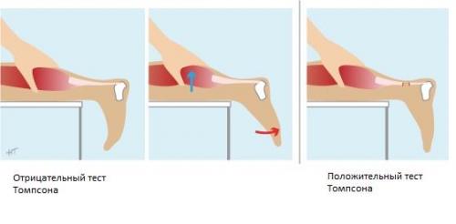 Травматические повреждения мышц и сухожилий на уровне голени: причины, симптомы и лечение 02