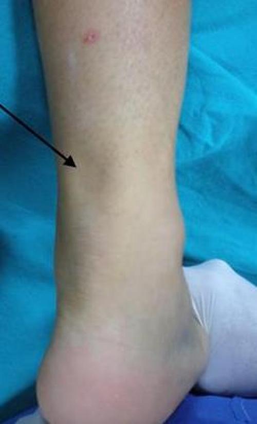 Травматические повреждения мышц и сухожилий на уровне голени: причины, симптомы и лечение 01