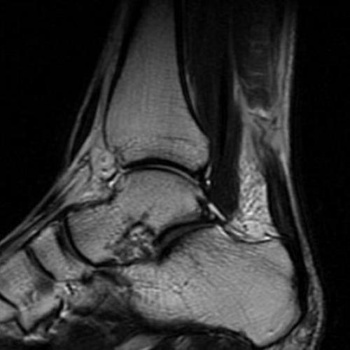 Травматические повреждения мышц и сухожилий на уровне голени: причины, симптомы и лечение 04