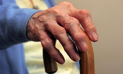 Могут ли женщины более подвержены риску развития артроза кистей и пальцев рук, чем мужчины. Cимптомы ревматоидного артрита у женщин: особенности проявления