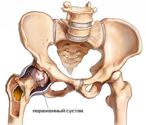 Как восстановить хрящевую ткань тазобедренного сустава. Чем опасно разрушение тазобедренного сустава: признаки и симптомы, тактика лечения