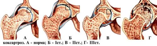 Как восстановить хрящевую ткань тазобедренного сустава. Чем опасно разрушение тазобедренного сустава: признаки и симптомы, тактика лечения