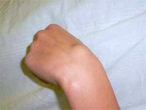 Различия между липомой и атеромами: что вам нужно знать 01