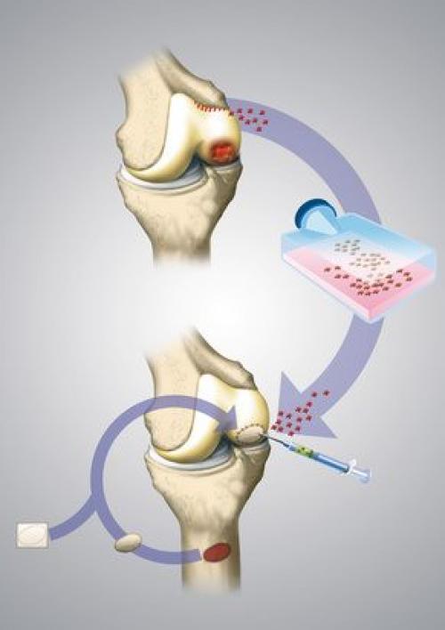 Восстановления хрящевой ткани коленного сустава. Как проходит артроскопическая трансплантация хондроцитов?