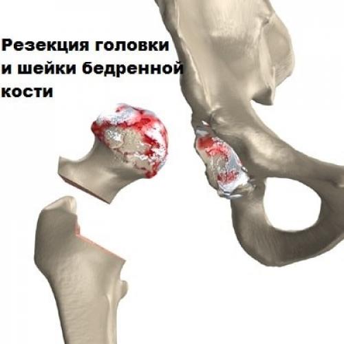 Способы реабилитации после перелома шейки бедра. Особенности реабилитации после перелома шейки бедра 04 Способы реабилитации после перелома шейки бедра. Особенности реабилитации после перелома шейки бедра 04