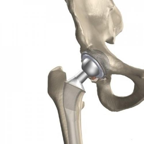 Способы реабилитации после перелома шейки бедра. Особенности реабилитации после перелома шейки бедра 09 Способы реабилитации после перелома шейки бедра. Особенности реабилитации после перелома шейки бедра 09