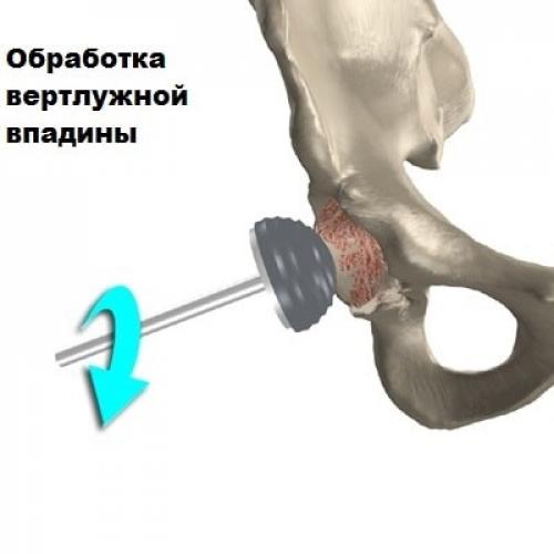 Способы реабилитации после перелома шейки бедра. Особенности реабилитации после перелома шейки бедра 05 Способы реабилитации после перелома шейки бедра. Особенности реабилитации после перелома шейки бедра 05