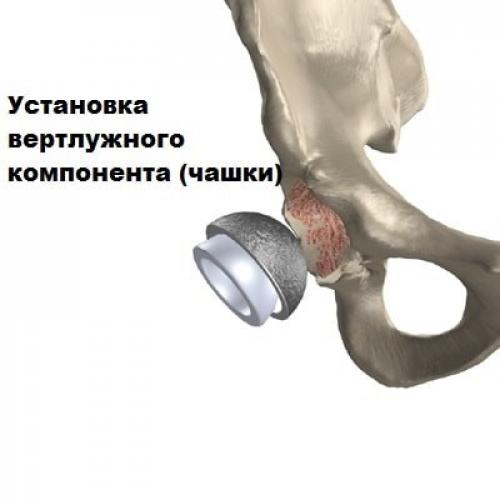 Способы реабилитации после перелома шейки бедра. Особенности реабилитации после перелома шейки бедра 06 Способы реабилитации после перелома шейки бедра. Особенности реабилитации после перелома шейки бедра 06