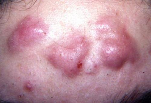 Лечение прыщей: самые эффективные советы экспертов 02 Лечение прыщей: самые эффективные советы экспертов 02