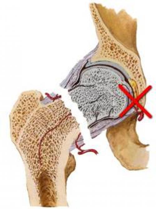 Трещина в тазобедренном суставе лечение. Признаки и симптомы перелома шейки бедра у пожилых и молодых людей