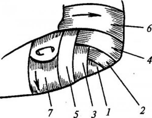 Можно ли использовать черепашью сходящуюся повязку для предотвращения травм локтевого сустава. Черепичная (черепашья)