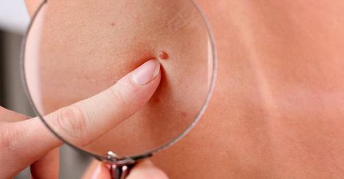 Доброкачественные и злокачественные кожные образования. Непигментные доброкачественные новообразования кожи 01