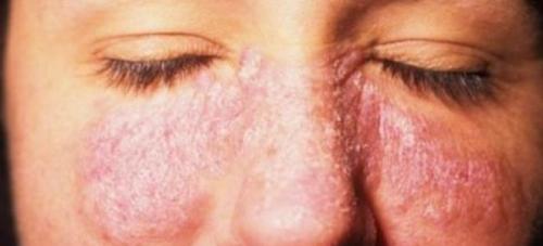 Псориаз и современные методы его лечения. Эффективность менее современных методов лечения псориаза 01