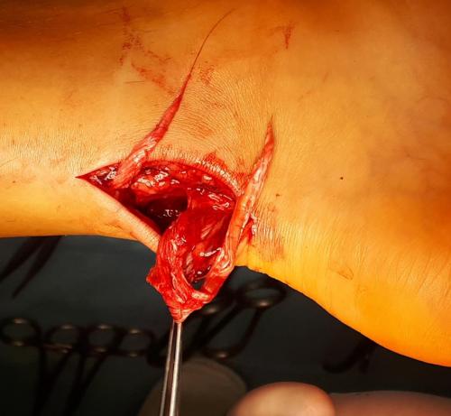 Восстановление после операции при разрыве ахиллова сухожилия. Восстановление после операции 01