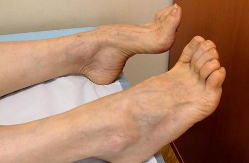 Лечение болевой формы диабетической полинейропатии. Лечение диабетической полиневропатии 01 Лечение болевой формы диабетической полинейропатии. Лечение диабетической полиневропатии 01