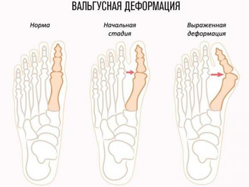 Болит косточка на ноге чем мазать народные средства. Что такое вальгусная деформация стоп?