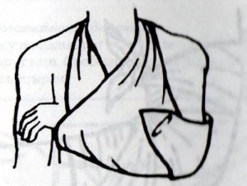 Какие виды заболеваний могут быть облегчены с помощью сходящихся и расходящихся повязок. Косыночные повязки