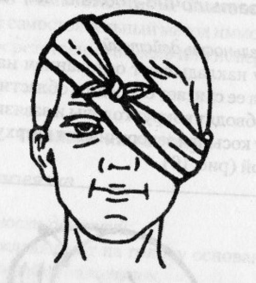 Какие виды заболеваний могут быть облегчены с помощью сходящихся и расходящихся повязок. Косыночные повязки