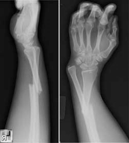 Перелом лучевой кости руки со смещением лечение, срок срастания. Виды переломов луча