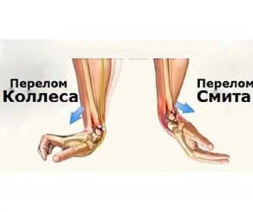 Перелом лучевой кости руки со смещением лечение, срок срастания. Виды переломов луча