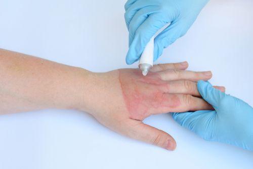 Современное лечение гнойных ран в домашних условиях. Как можно ускорить заживление ран 03