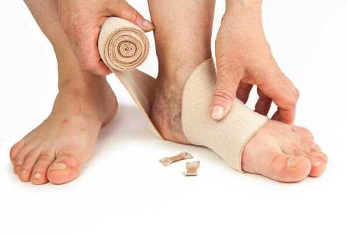 Как правильно бинтовать ногу эластичным бинтом при варикозе. Бандажирование нижних конечностей 03