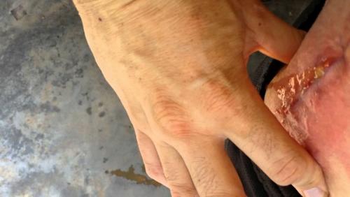 Реабилитация после эндопротезирования коленного сустава. Замена коленного сустава, реабилитация после операции 08