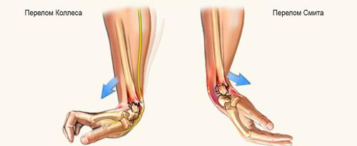 Профилактика растяжений и вывихов. Оказание первой помощи при травмах опорно-двигательного аппарата 01