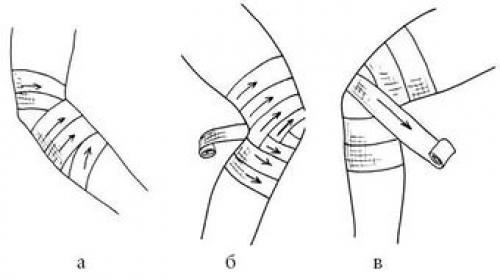 Общие принципы наложения эластичных бинтов. Как правильно накладывать эластичный бинт? 10 Общие принципы наложения эластичных бинтов. Как правильно накладывать эластичный бинт? 10