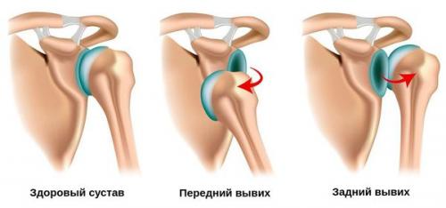 Профилактика растяжений и вывихов. Оказание первой помощи при травмах опорно-двигательного аппарата 02