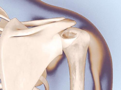 Профилактика растяжений и вывихов. Оказание первой помощи при травмах опорно-двигательного аппарата 03