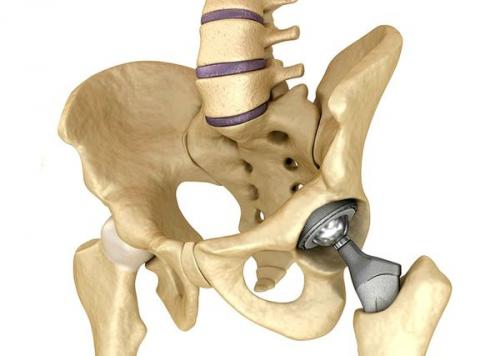 Медикаментозное лечение коксартроза тазобедренного сустава. Лечение коксартроза 03 Медикаментозное лечение коксартроза тазобедренного сустава. Лечение коксартроза 03