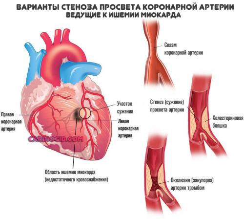 Таблетки от сердечной недостаточности без рецепта. Таблетки от боли в сердце: список названий и виды препаратов, принцип действия и совместимость